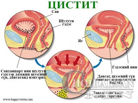 ЦИСТИТ өвчлөл, эмчилгээ